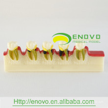 EN-M8 Dental Disease Developing Model/Dental Disease Model